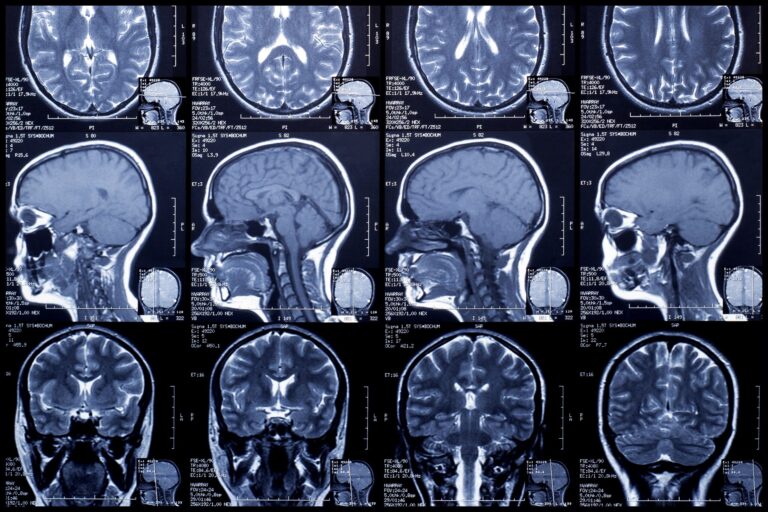 Abu Dhabi hospital reveals new brain scan to detect Alzheimer’s earlier